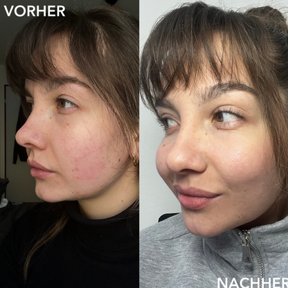 GLOW-UP™ - LED Therapie Maske